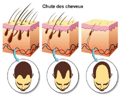 chute des cheveux en Tunisie